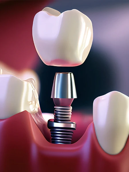 Pourquoi choisir Umut Dental Clinic pour vos implants dentaires?