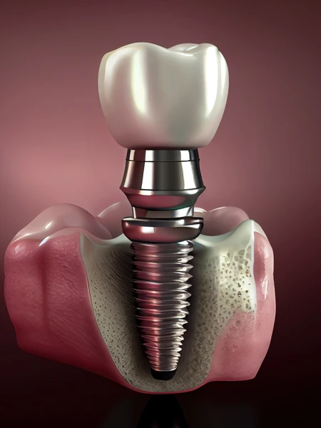 Pourquoi choisir la clinique dentaire Umut Antalya?