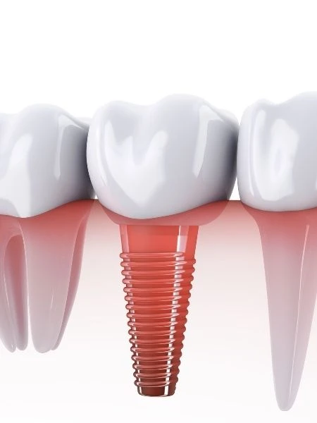 Преимущества зубных имплантатов All-on-4